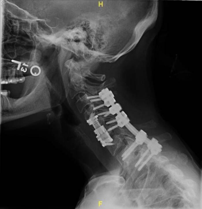 We will create an algorithm enabling users to upload both the “pre” and “post” images, realign/manipulate them, and eliminate noise induced by movement of the patient. By doing so, the lab will be able to make more accurate diagnoses and prognoses of their patients. Having specific, quantitative data on the relative positions and movements of screws and vertebral bodies of interest would help patients to make the best of their own and the lab’s time and diagnose any complications earlier for better health and less cost to the patient.